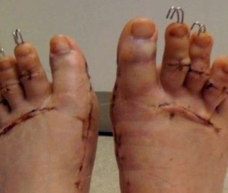 Γυναίκες κόβουν τα δάχτυλα των ποδιών τους για να φορούν πέδιλα