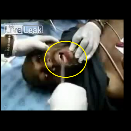 VIDEO: Γιατρός αφαιρεί τηλέφωνο από το λαιμό ενός ανθρώπου