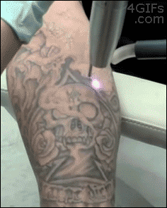 laser-tattoo