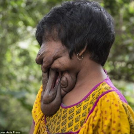 Η 21χρονη από την Ινδία που δεν έχει “πρόσωπο”!