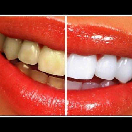 6 Τρόποι να λευκάνεις τα δόντια σου στο σπίτι!