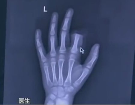11χρονος έκοψε το δάχτυλο του επειδή ήταν κολλημένος με το…