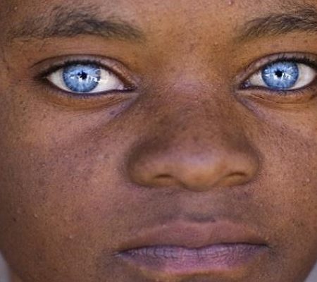 Πώς γίνεται να γεννιούνται παιδιά στην Αφρική με μπλε μάτια!