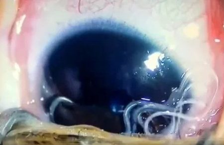 Στην Κίνα Γιατροί Ανακάλυψαν 11 Ζωντανά Σκουλήκια στο Μάτι Μωρού!